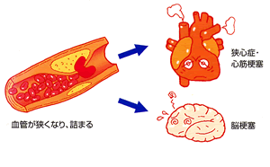 動脈硬化とは？